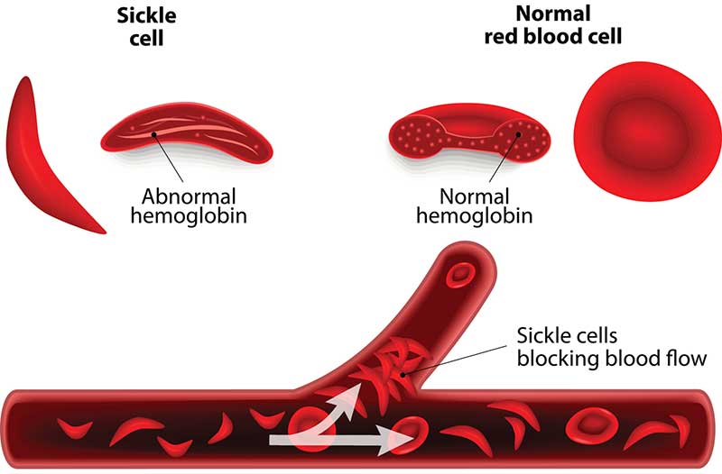 sickle cell anemia hand foot syndrome